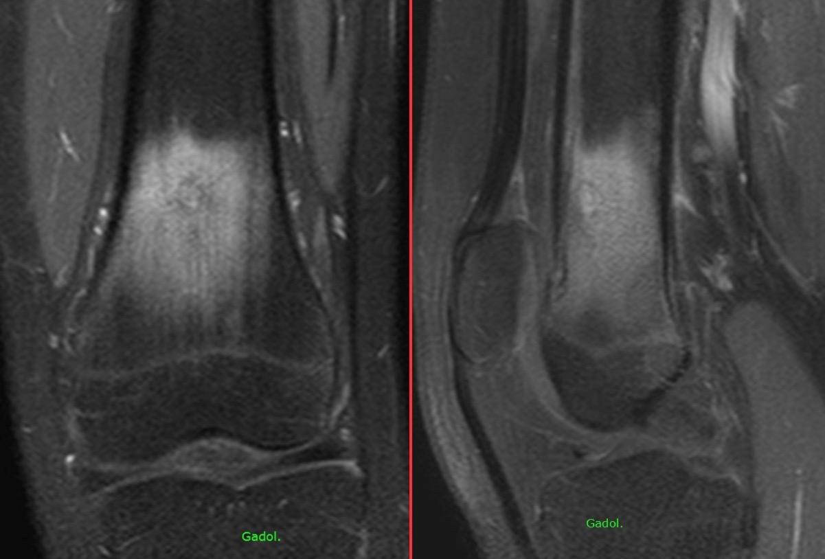 Figure 5 for case osteoid osteoma ( RID4005 )